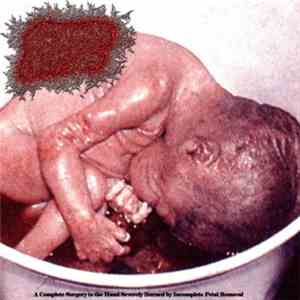 Clogged Orifice - A Complete Surgery to the Hand Severely Burned by Incomplete Fetal Removal FLAC