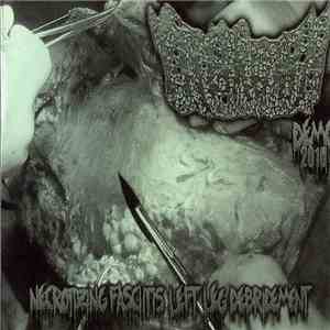 Ingrown - Necrotizing Fascitis Left Leg Debridement FLAC