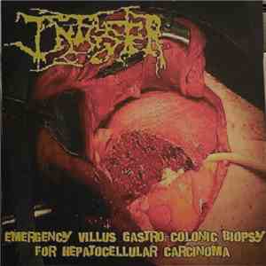 Infester - Emergency Villus Gastro-colonic Biopsy For Hepatocellular Carcinoma FLAC